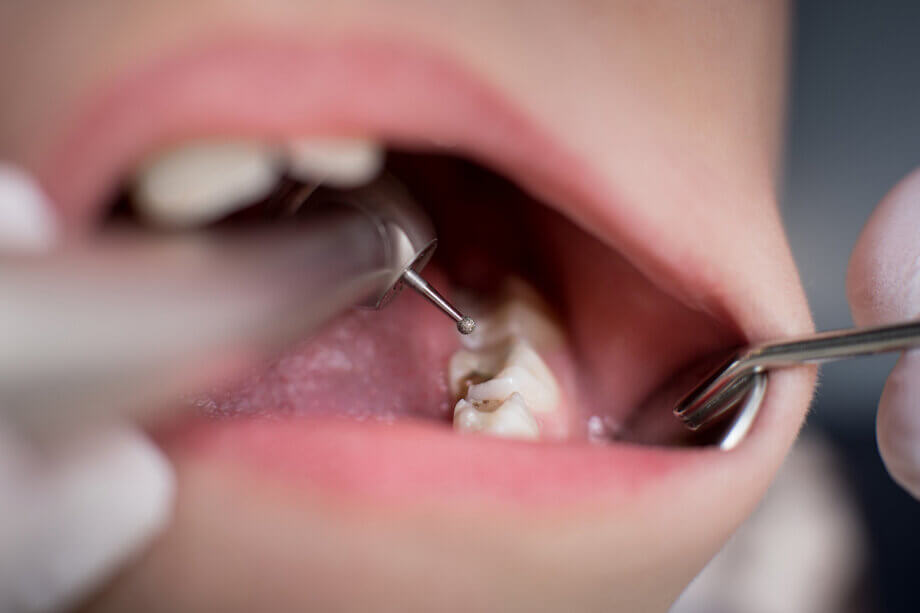 5 Signs You May Need a Dental Filling (Even If You Don’t Feel Pain)