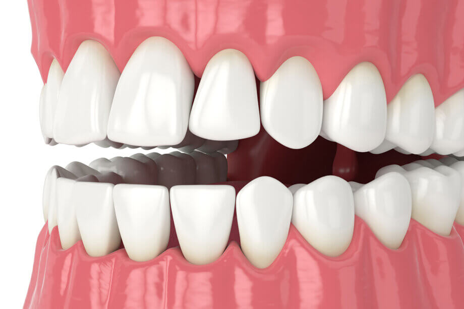 BioClear: A Modern, Conservative Way to Transform Your Smile