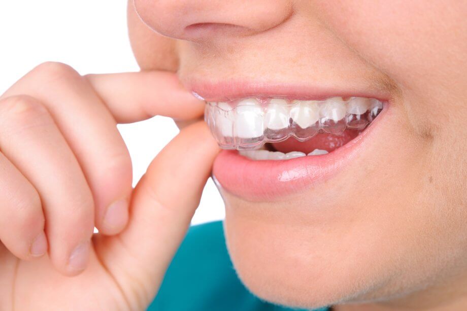 Can I Get Invisalign if I Grind My Teeth?