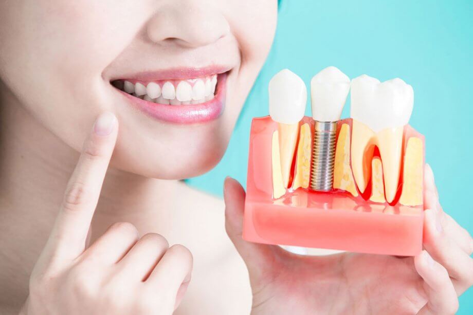 The 5 Benefits of Dental Implants