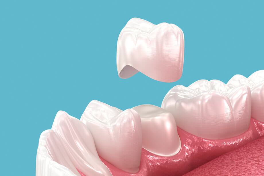 How to Care for Your New Dental Crown to Make It Last Longer