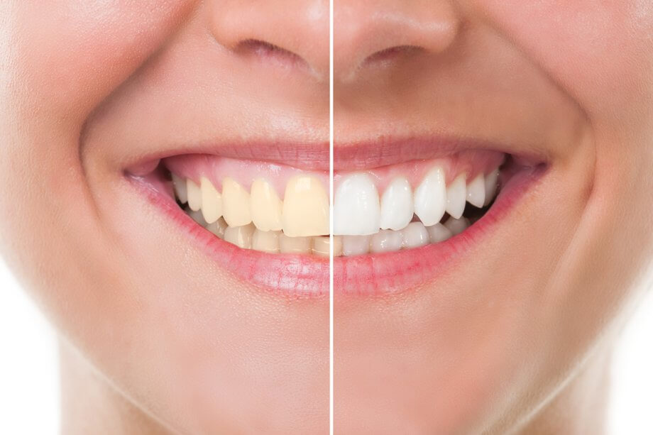 How to Maintain Your Teeth Whitening Results After Treatment in Kensington, MD