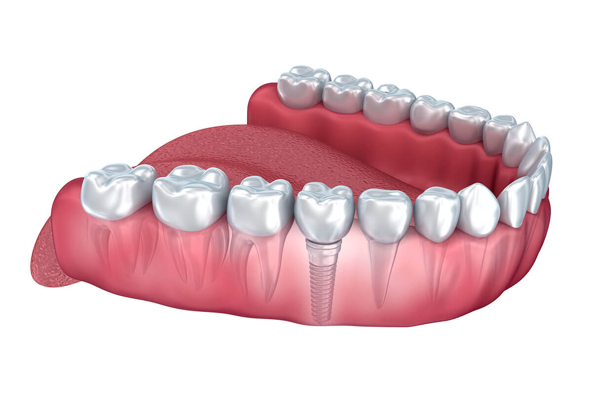 Single Tooth Dental Implant Illustration