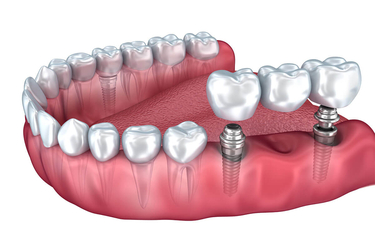 Implant Supported Bridge in Kensington