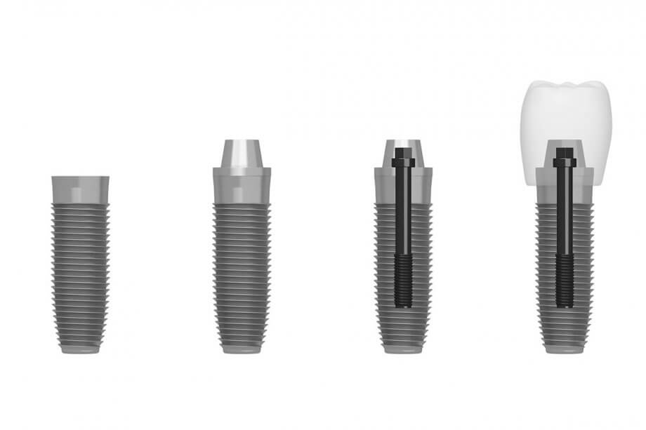 A Step by Step Guide to Dental Implants