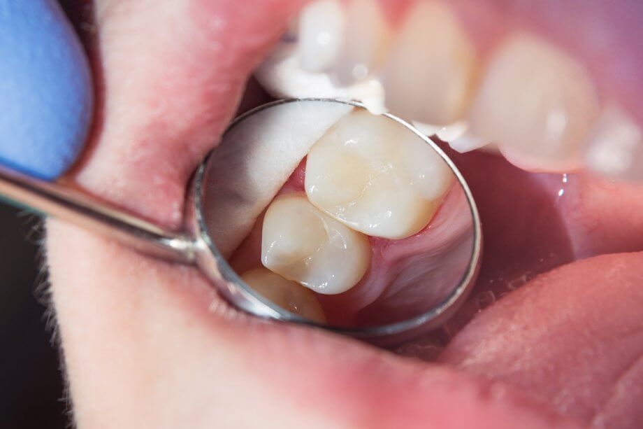 Tooth-Colored Fillings vs Amalgam Fillings What You Need to Know
