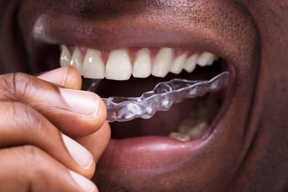 man inserting Invisalign aligner tray