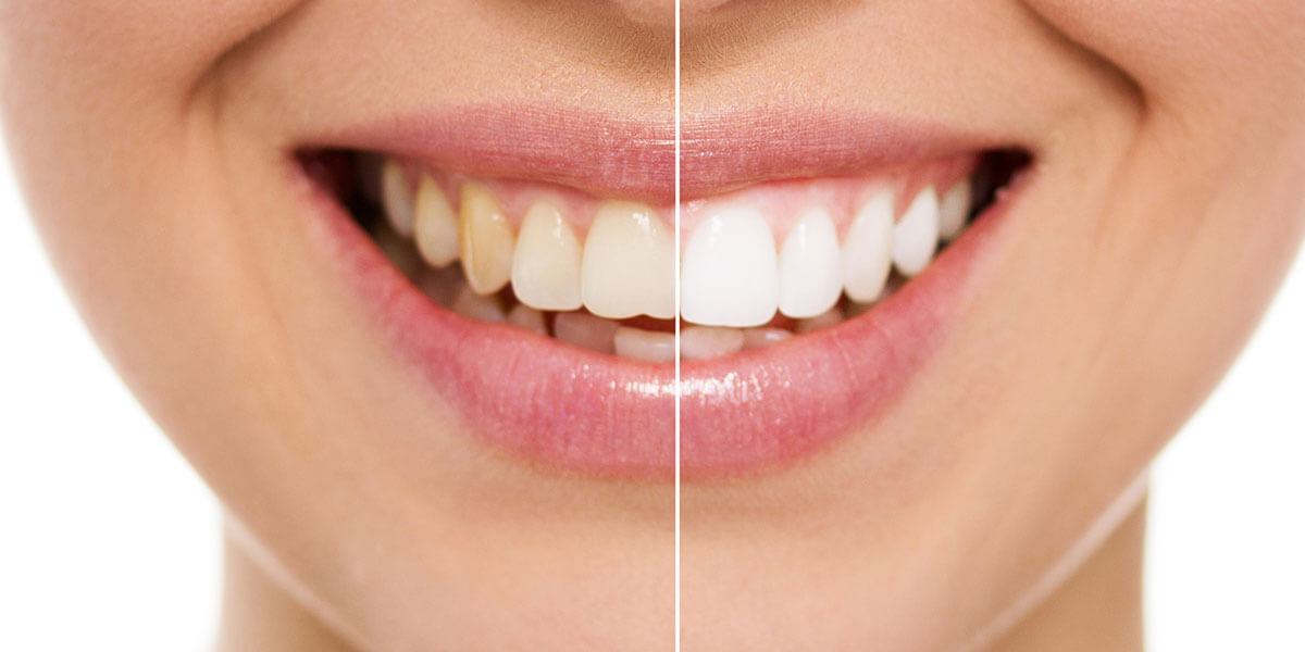 Before & After Teeth Whitening in Kensington